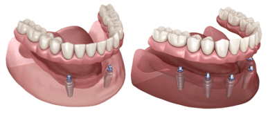 Fixed/Non Removable Teeth on Implants - Hood River, The Dalles, Hermiston –  Your Denture and Implant Specialist