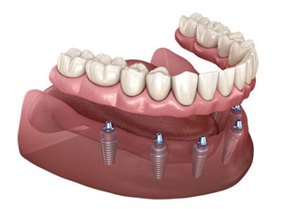 Fixed/Non Removable Teeth on Implants - Hood River, The Dalles, Hermiston –  Your Denture and Implant Specialist