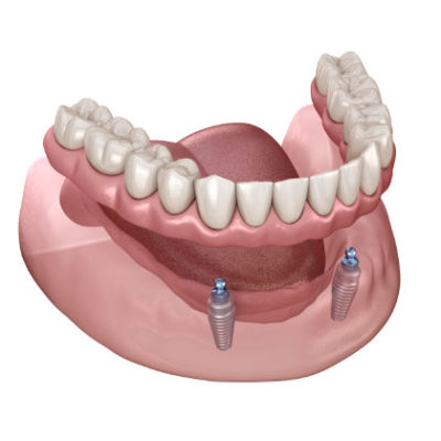 Removable Dentures On Implants 400x400 